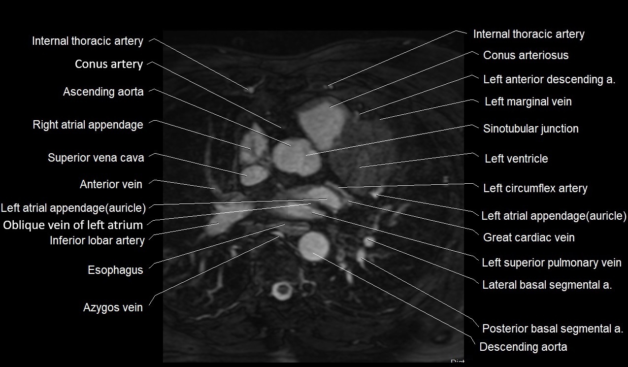 MRI heart coronary arteries and coronary veins anatomy axial image 15.jpg